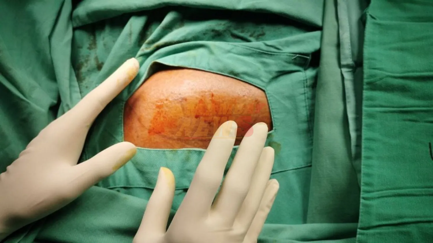 Extirpan tumor de más de 60 kilogramos a un hombre en Rusia; vivió con este más de 20 años
