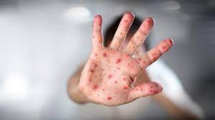Salud analiza caso sospechoso de viruela del mono en Paraguay