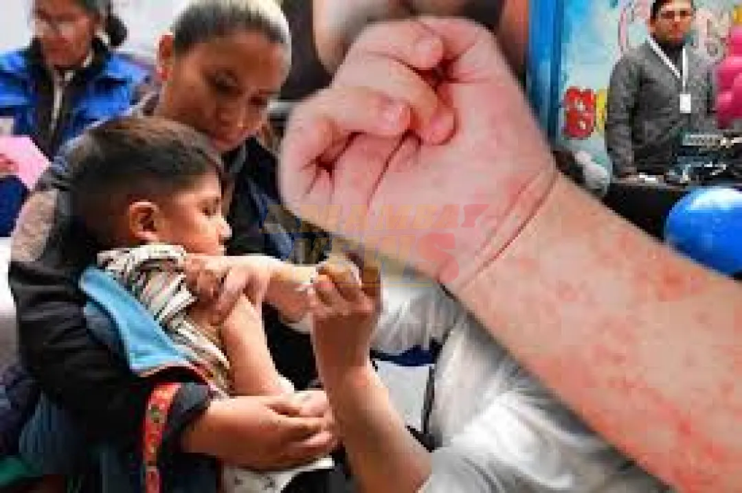 Sigue escalando el sarampión en Bolivia; 76 casos positivos