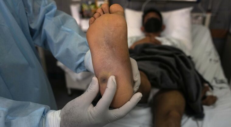 Viruela del mono: un caso confirmado y un sospechoso en estudio