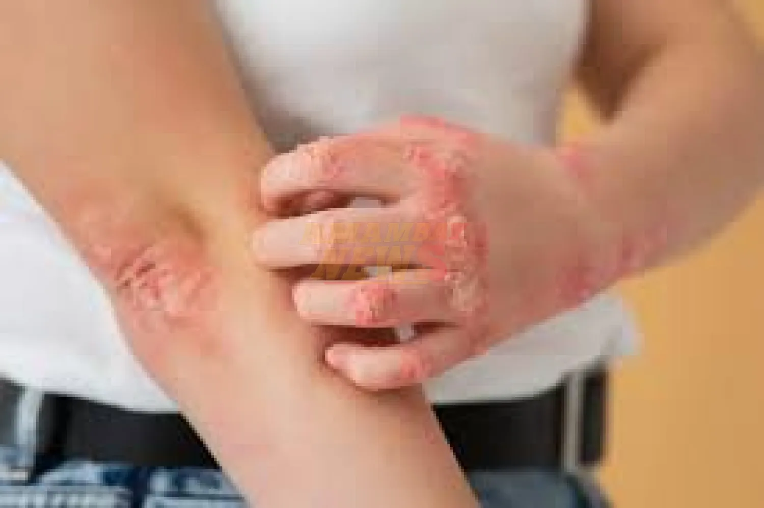 Día Mundial de la Epidermólisis Bullosa: una piel que enseña fortaleza