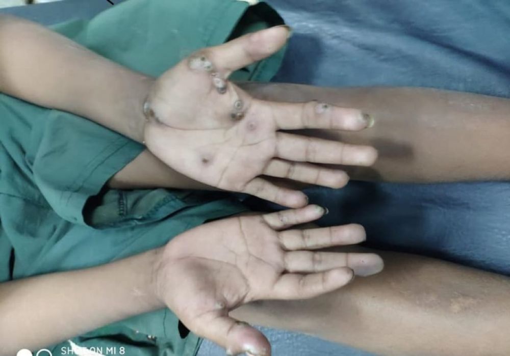 Rescatan a niño indígena con los pies y manos carcomidos por piques