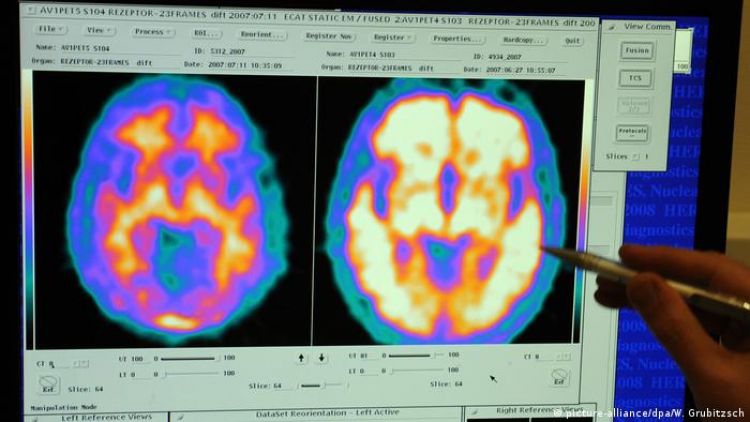 Nuevo estudio cuestiona duramente la principal teoría sobre las causas y tratamientos del Alzheimer