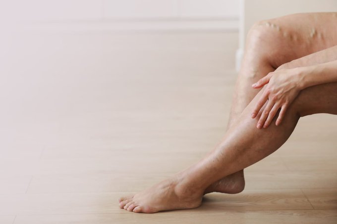Trombosis: Riesgos, síntomas y medidas de prevención
