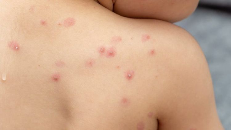 Chile decretó una alerta sanitaria tras confirmar seis casos de viruela símica