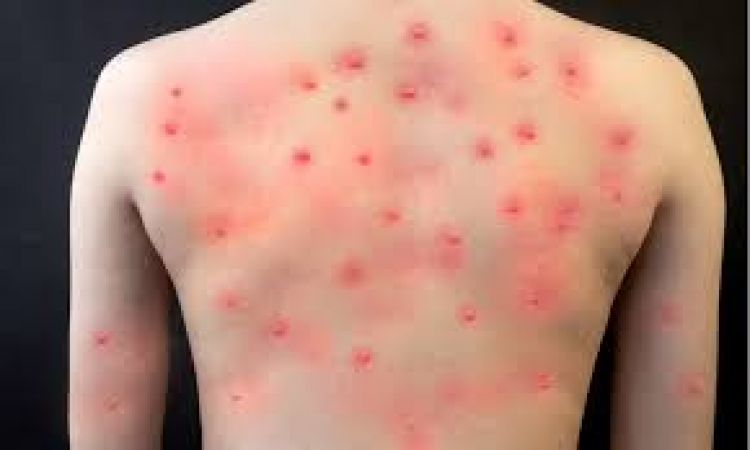 Casos de viruela del mono aumentan un 77 por ciento en una semana