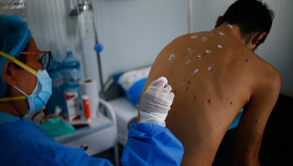 Salud confirma segundo caso de viruela símica en Paraguay