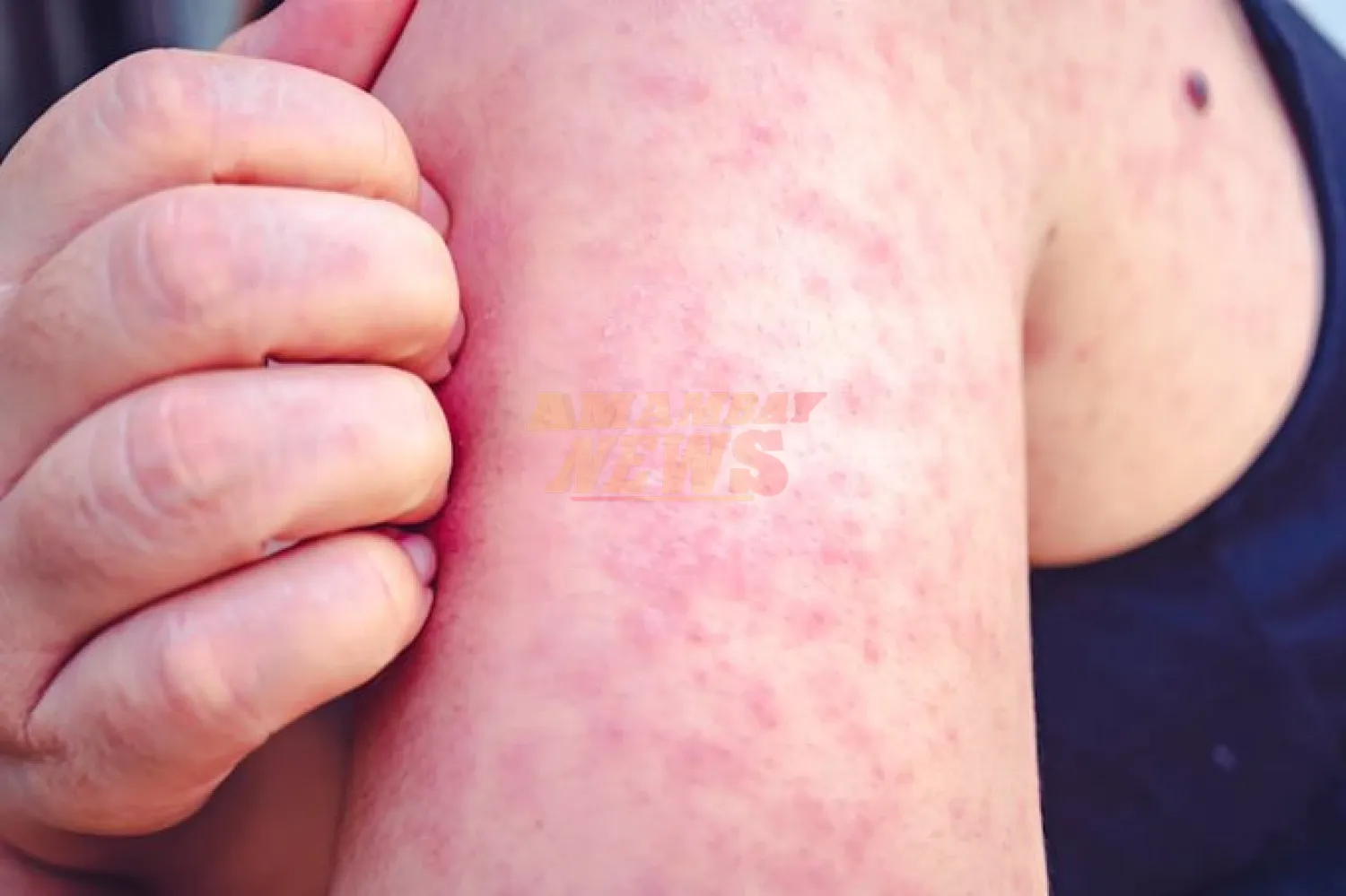 Paraguay cierra brote de sarampión tras tres meses sin nuevos contagios
