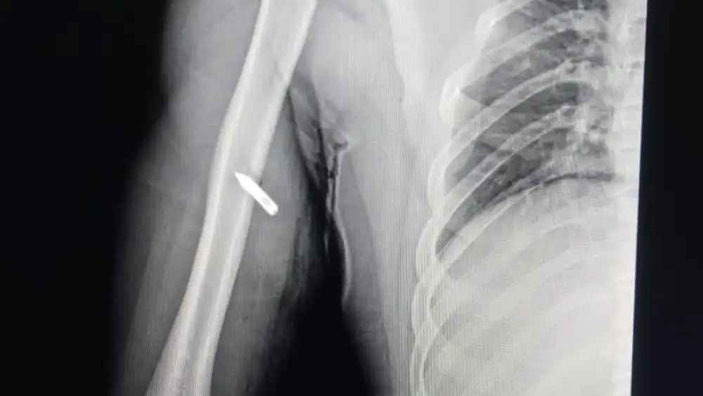 Hombre herido por policía de Puerto Guaraní fue trasladado a Concepción