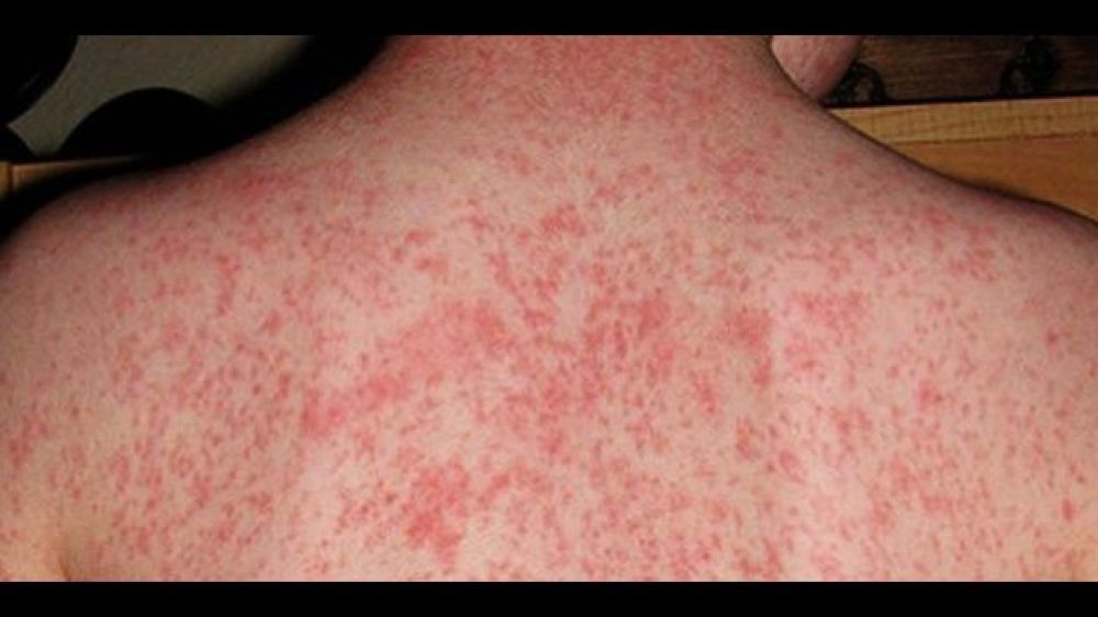 Descartan casos de sarampión en el país