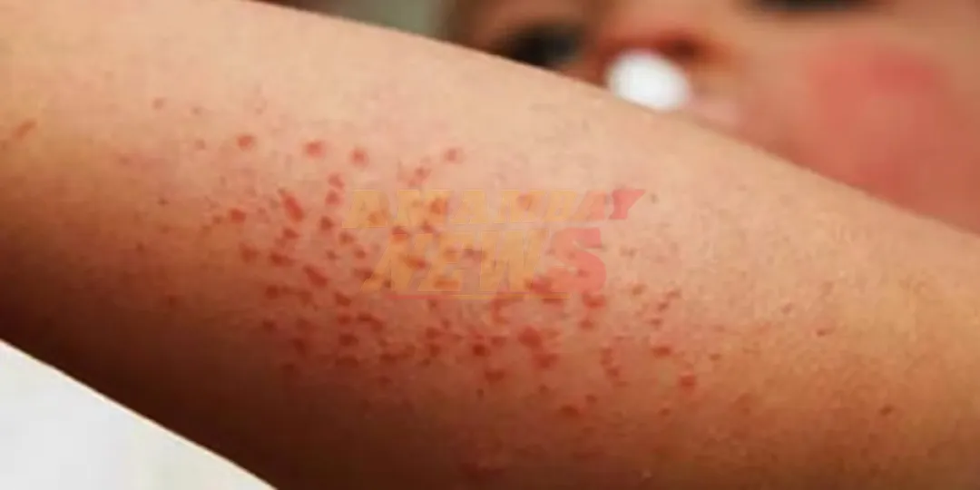 Sarampión: descartan caso sospechoso en Misiones