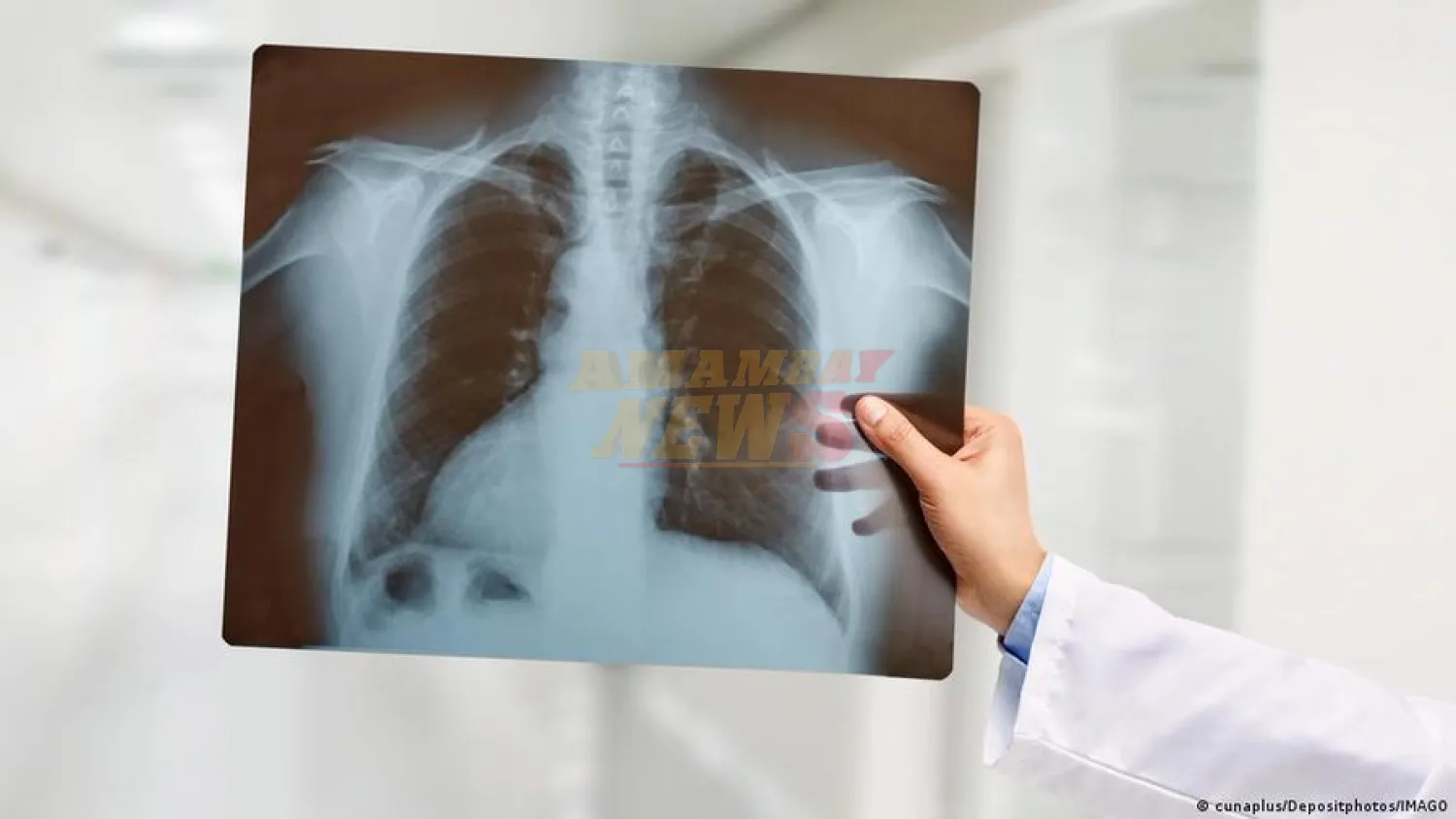 Un paciente sobrevive durante 48 horas sin pulmones
