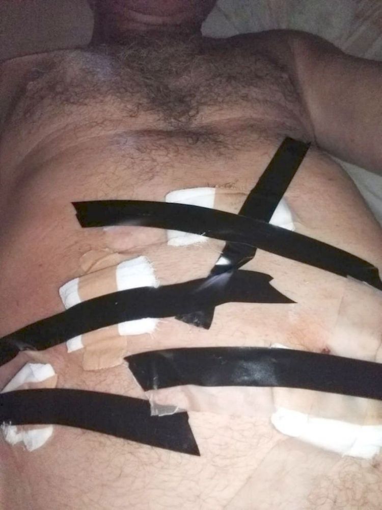 En hospital no había cinta médica y usaron aislante