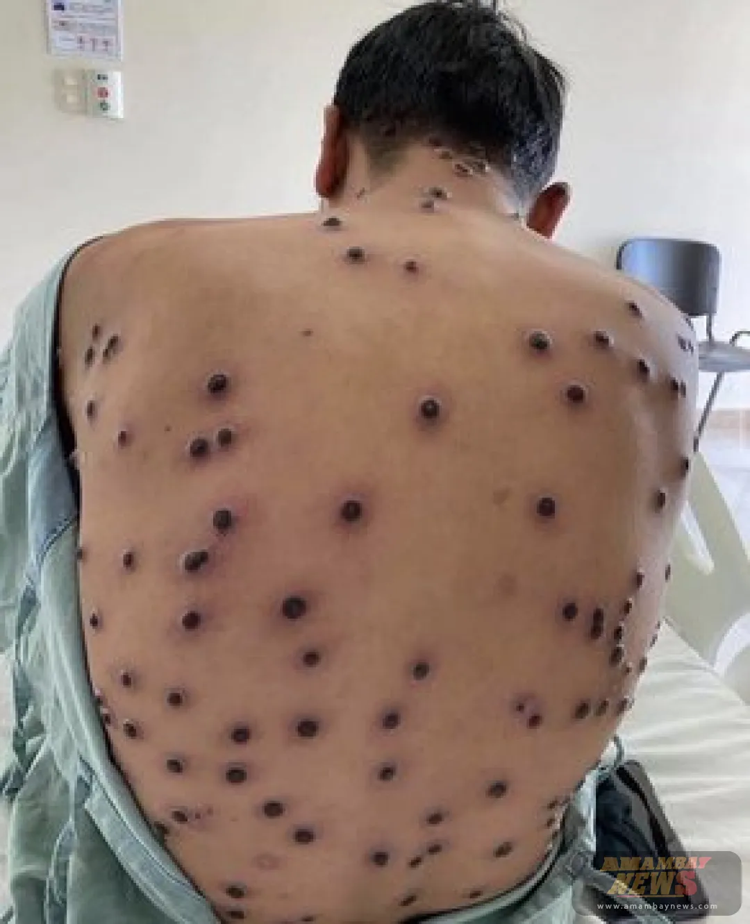 La OMS urgió aumentar la producción de vacunas contra el mpox