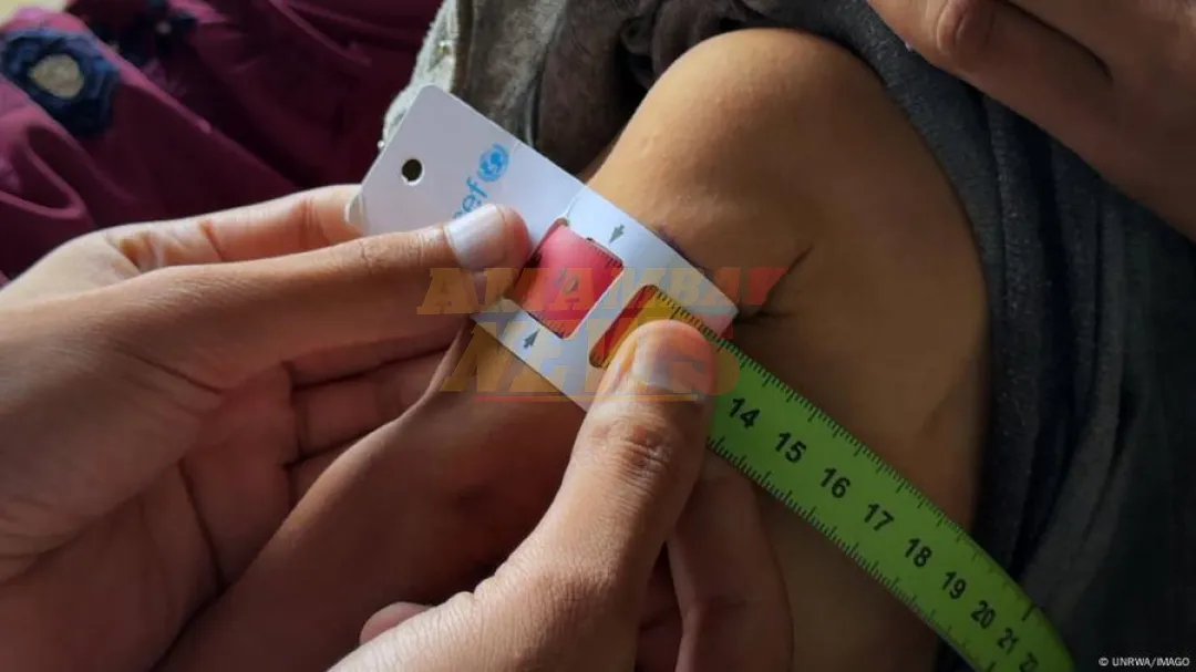 Van más de cien niños muertos por desnutrición en Gaza