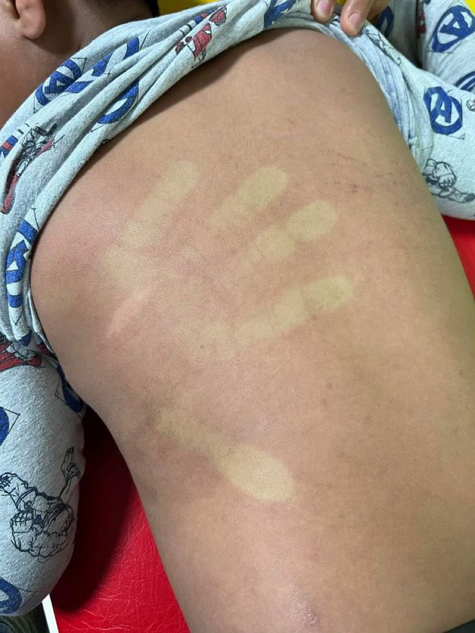 Dengue en niños: Síntomas y recomendaciones