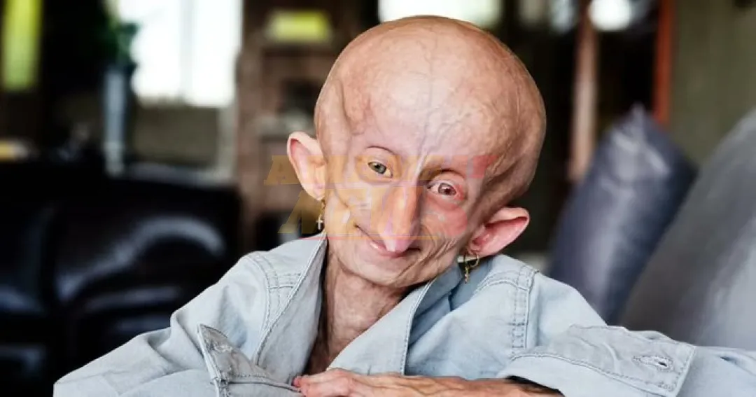 Muere a los 19 años la influencer Beandri Booysen, enferma de progeria