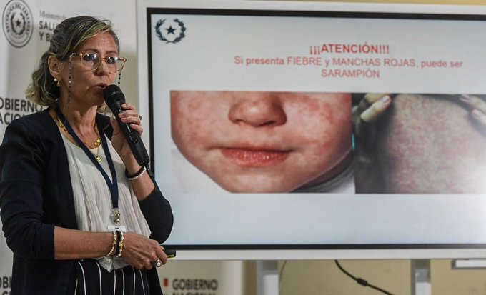 Alerta por sarampión: Salud intensificará vigilancia ante brote y síntomas similares a chikungunya
