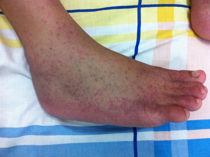 8 tips para aliviar las erupciones en la piel causadas por el chikungunya