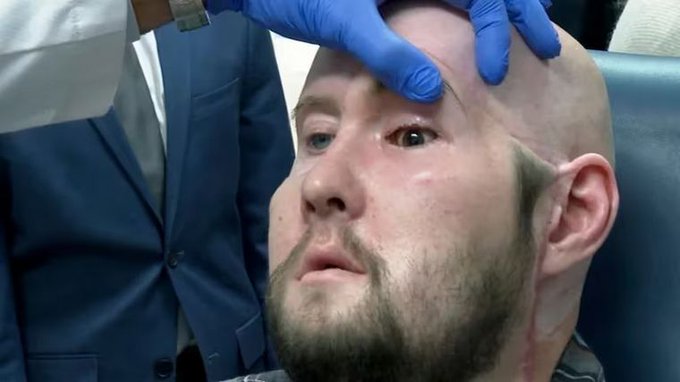 Primer trasplante de ojo completo del mundo es un éxito