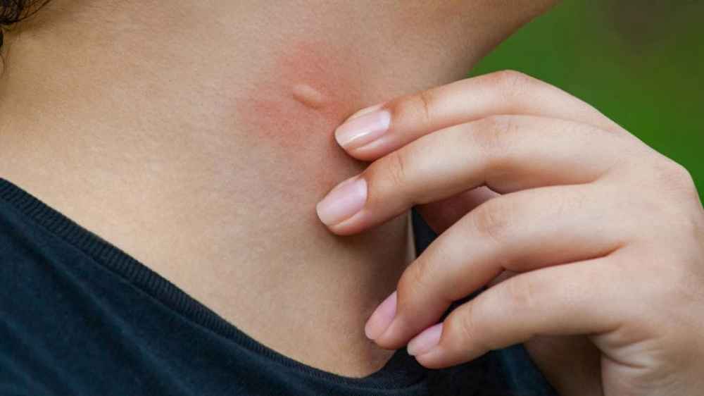 Confirman malaria en joven que vive en Foz de Yguazú y estudia en CDE