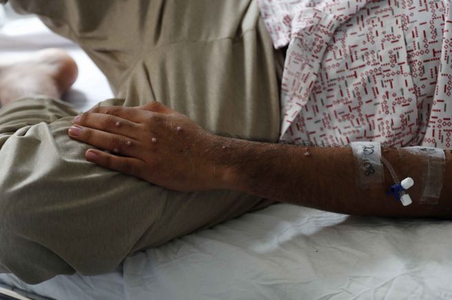 Salud reporta 44 casos de viruela del mono en el país