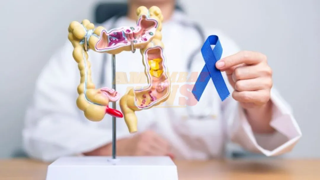 Médicos lamentan sobre detección tardía de cáncer colorrectal en el Paraguay