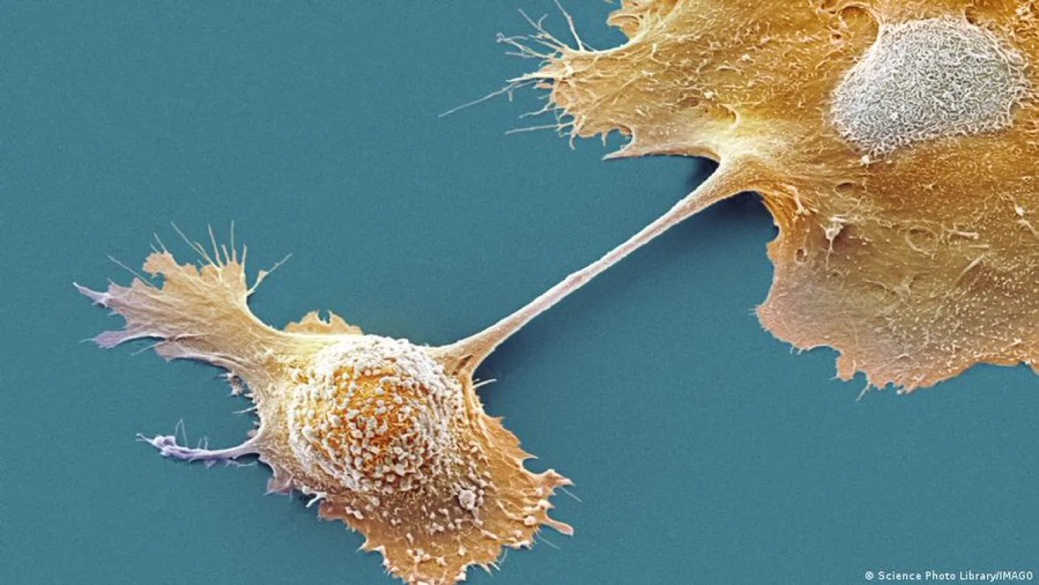Píldora casi duplica la supervivencia en cáncer de páncreas