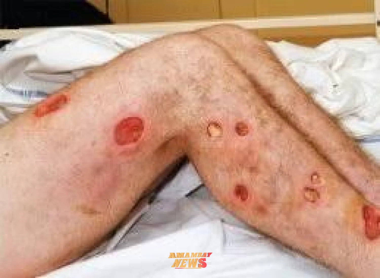 Internado por sospecha de botulismo fallece tras varios días en terapia en IPS