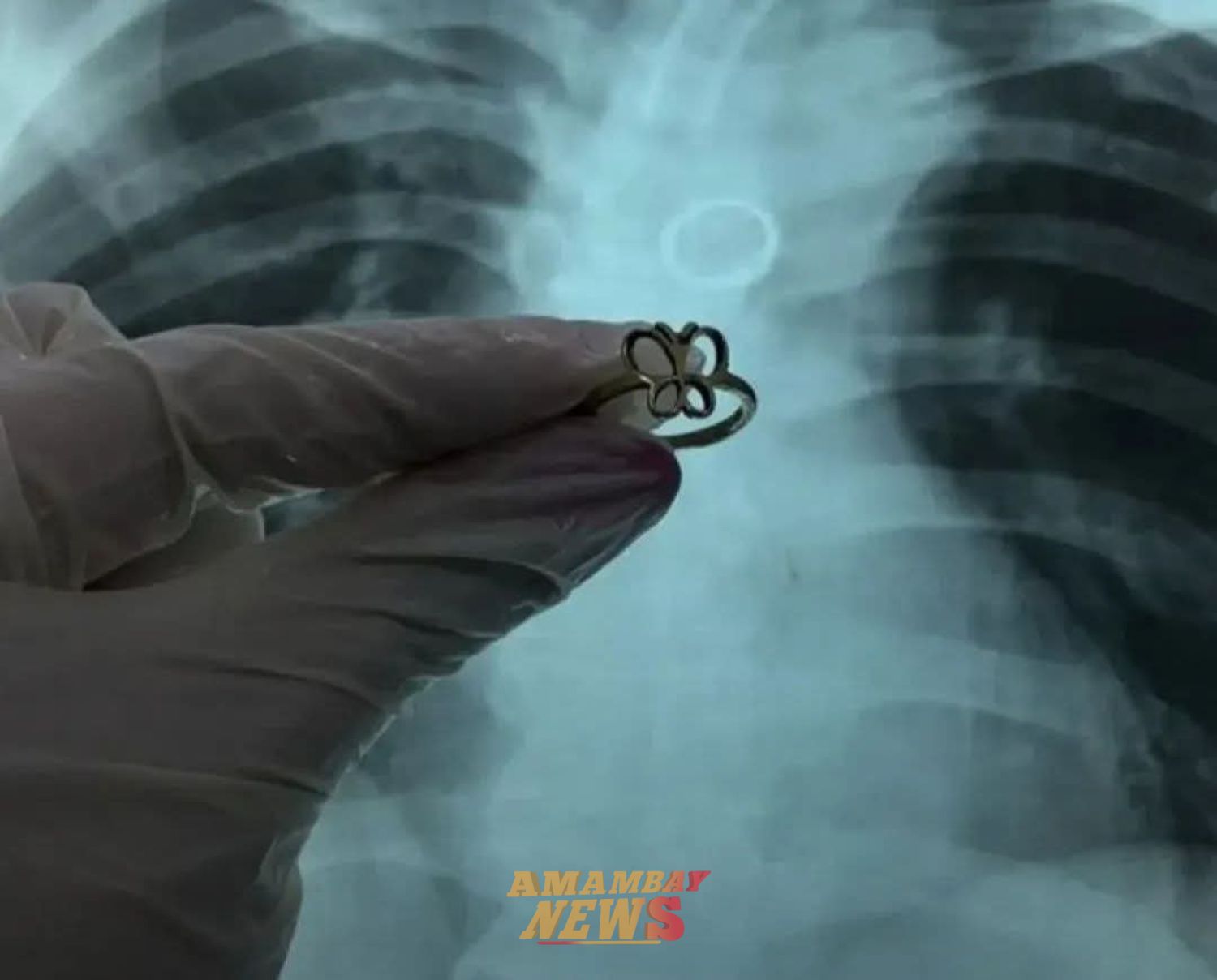 Hallan un anillo de oro en el pulmón de un paciente