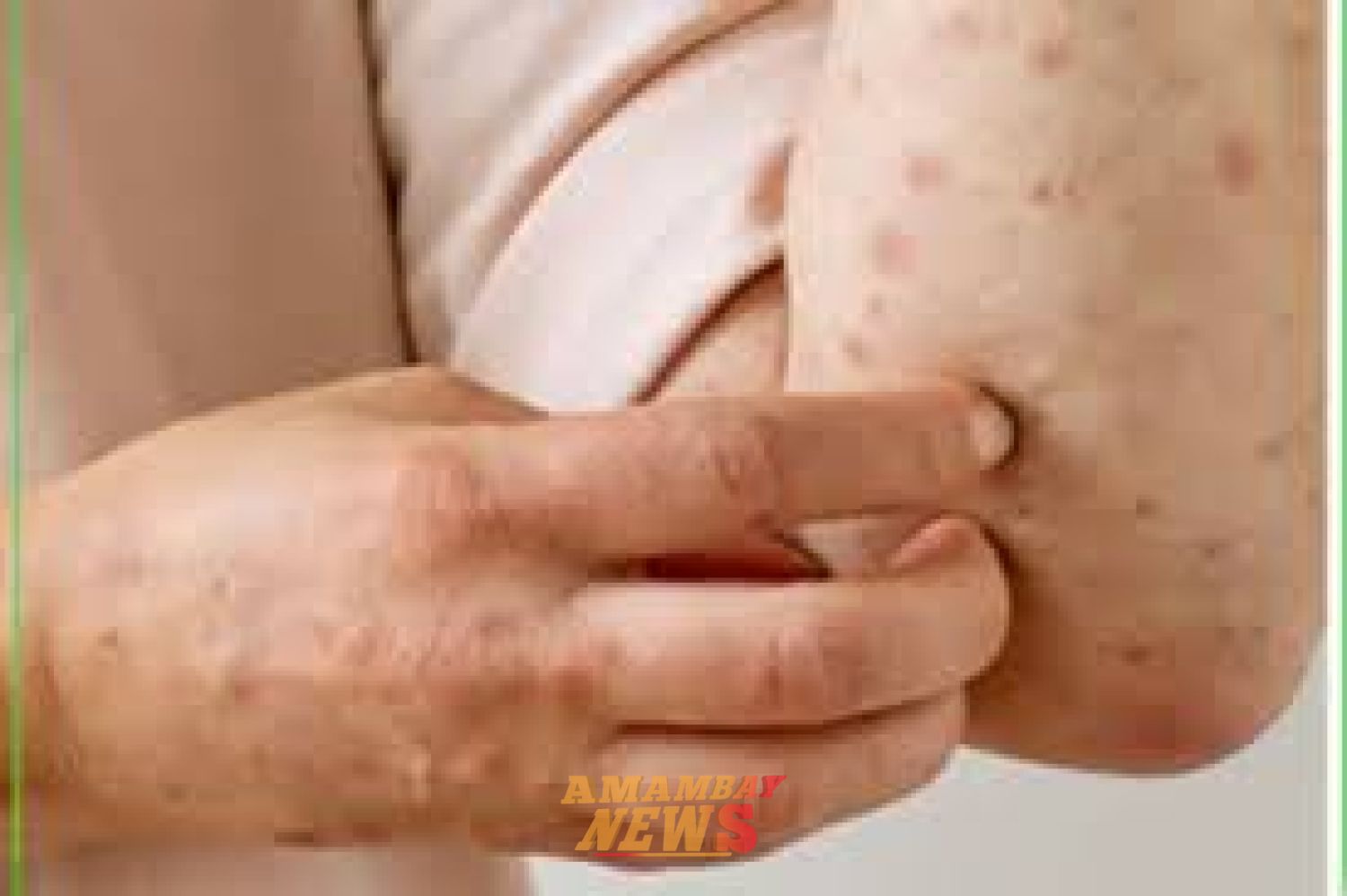 Detectan caso de mpox en Foz de Yguazú